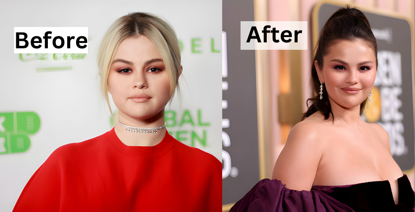 Selena Gomez before and after 